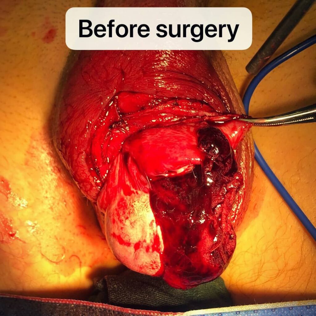 Exposed ruptured testicle before surgical intervention