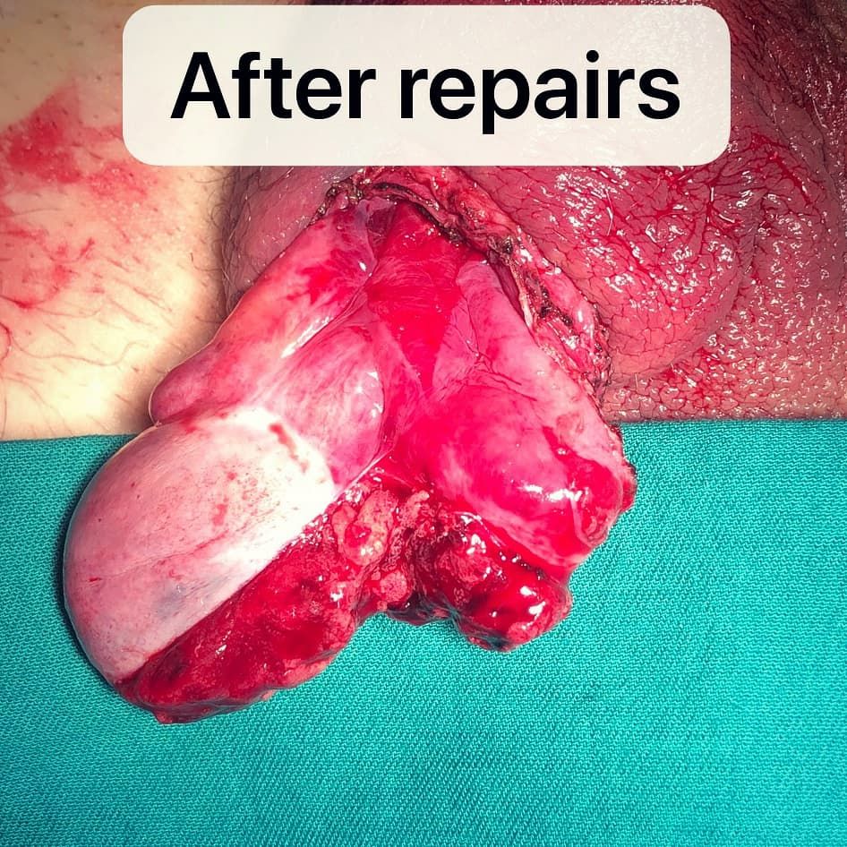 Testicle mid-surgery after repair of rupture from Muay Thai injury