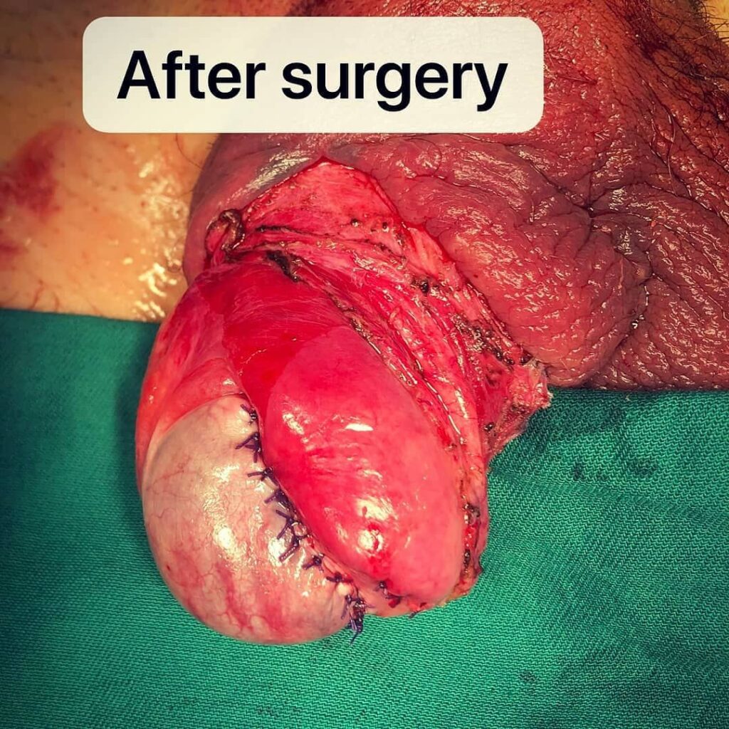 Post-surgical photo of ruptured testicle after Muay Thai injury in China